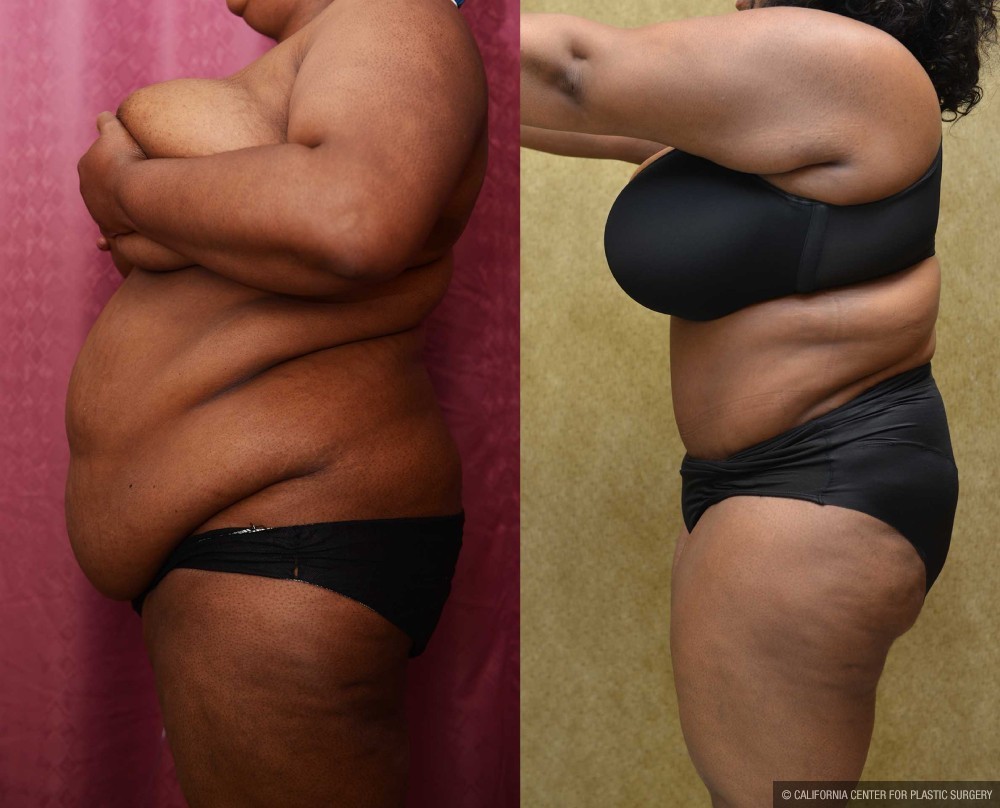 African American Tummy Tuck (Abdominoplasty) Before & After Patient #13434