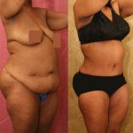 African American Tummy Tuck (Abdominoplasty) Before & After Patient #13473