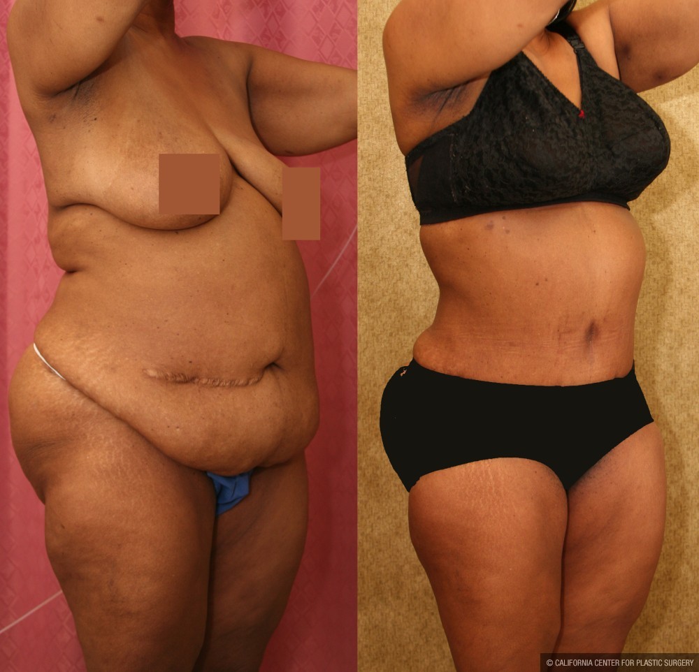 African American Tummy Tuck (Abdominoplasty) Before & After Patient #13473