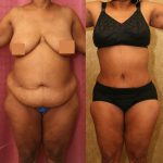 African American Tummy Tuck (Abdominoplasty) Before & After Patient #13473