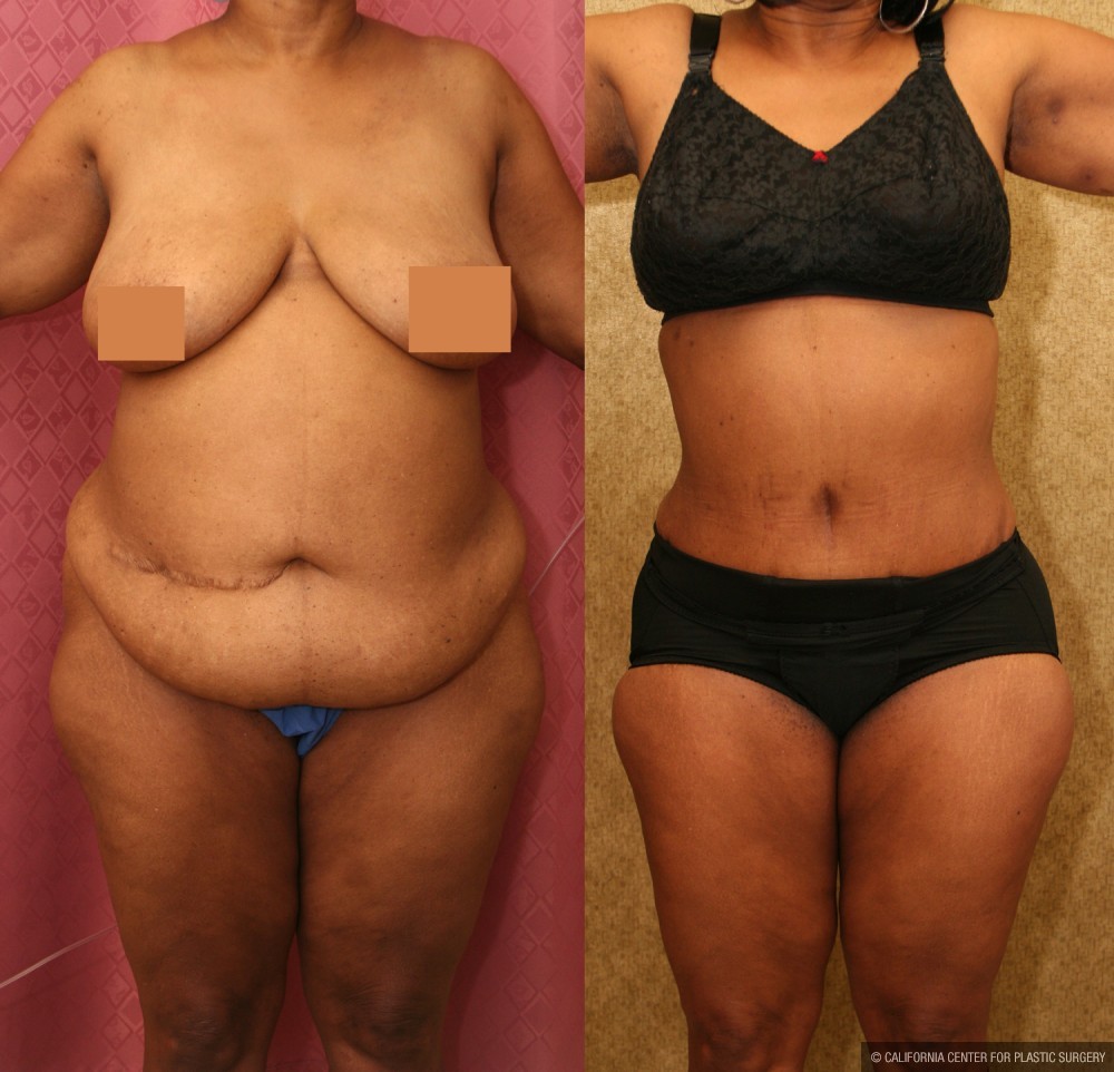 African American Tummy Tuck (Abdominoplasty) Before & After Patient #13473