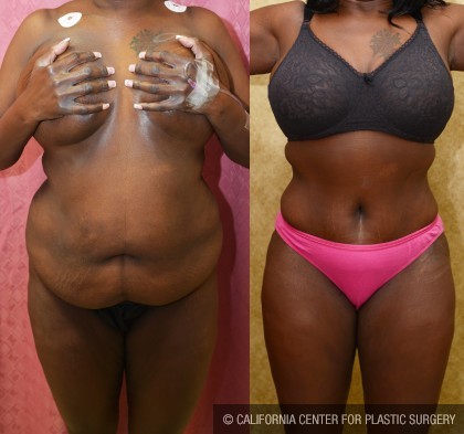 African American Tummy Tuck (Abdominoplasty) Before & After Patient #13465