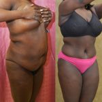 African American Tummy Tuck (Abdominoplasty) Before & After Patient #13465