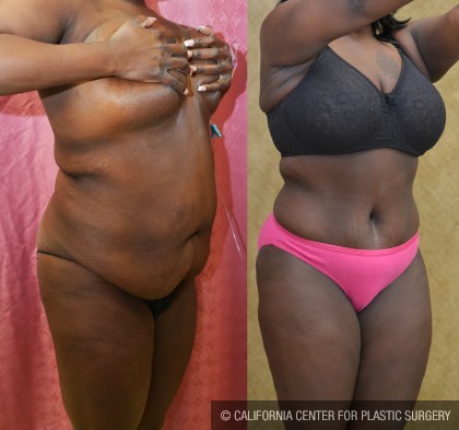 African American Tummy Tuck (Abdominoplasty) Before & After Patient #13465