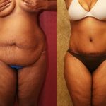 African American Tummy Tuck (Abdominoplasty) Before & After Patient #13455