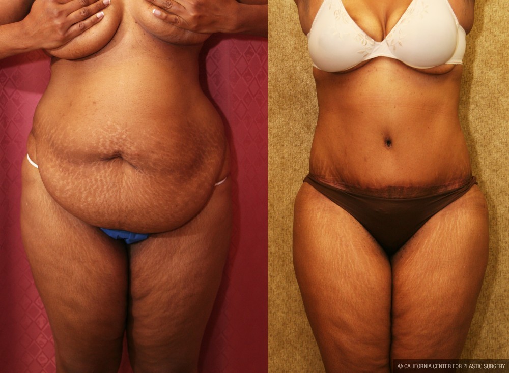 African American Tummy Tuck (Abdominoplasty) Before & After Patient #13455