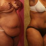 African American Tummy Tuck (Abdominoplasty) Before & After Patient #13455