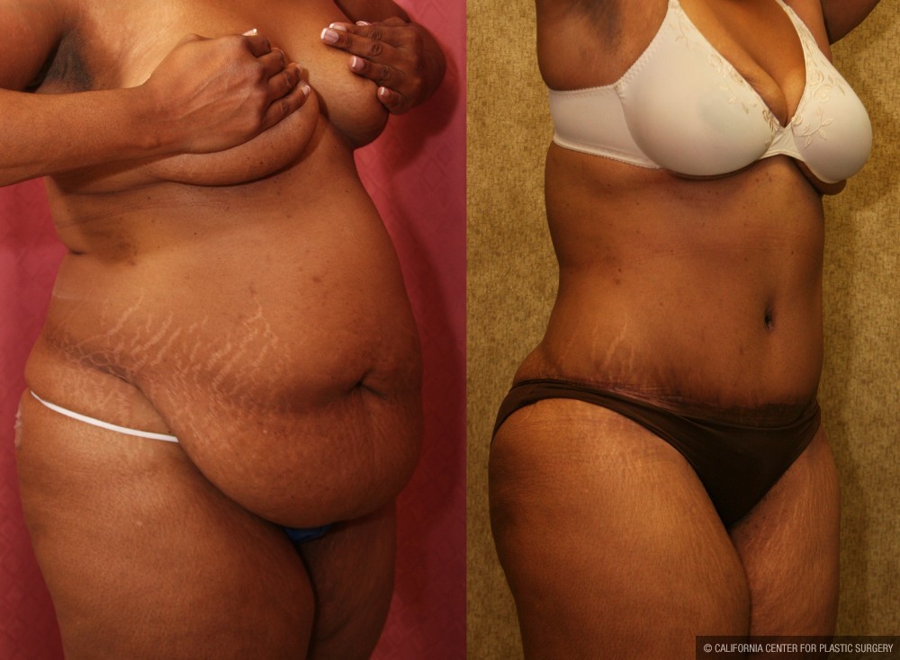 African American Tummy Tuck (Abdominoplasty) Before & After Patient #13455