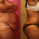 African American Tummy Tuck (Abdominoplasty) Before & After Patient #13455