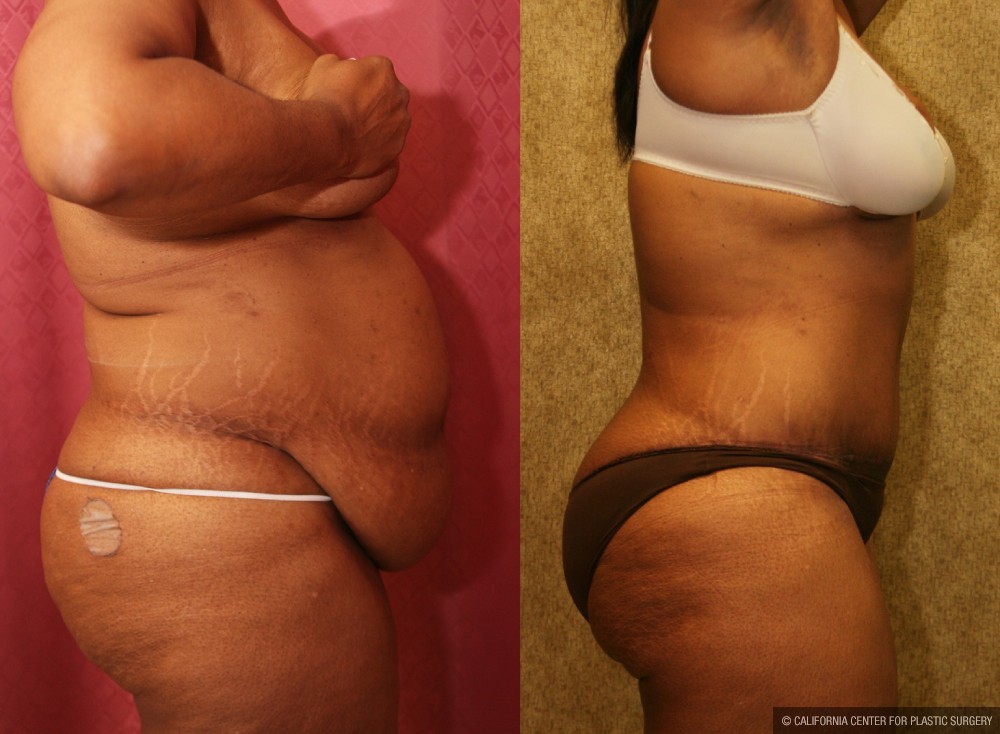 African American Tummy Tuck (Abdominoplasty) Before & After Patient #13455