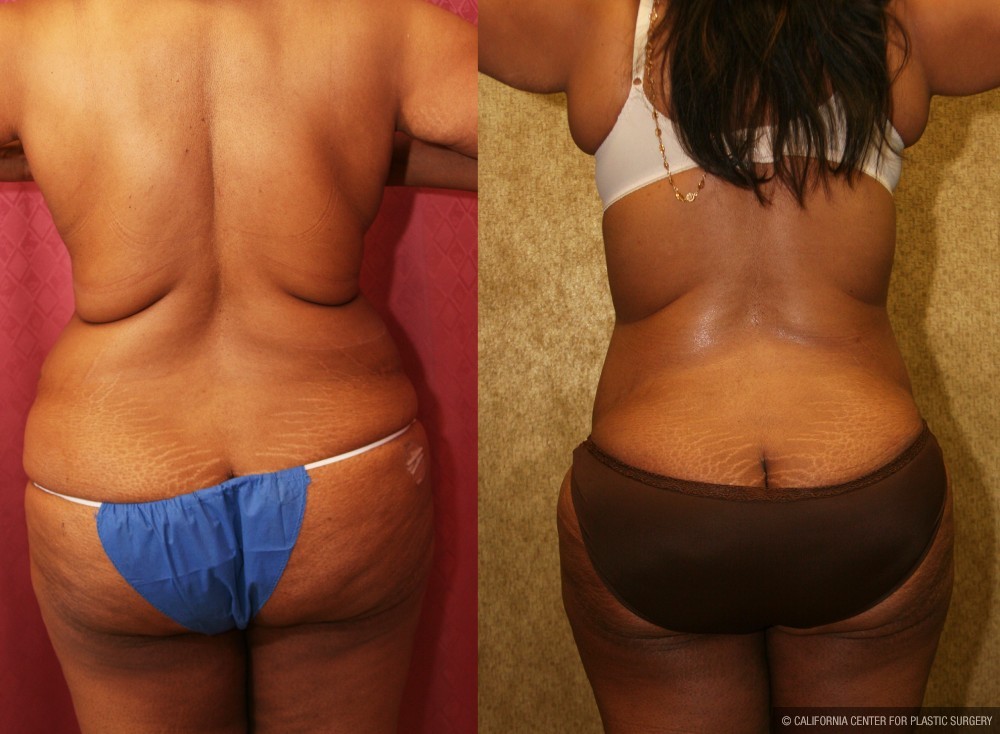 African American Tummy Tuck (Abdominoplasty) Before & After Patient #13455