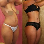 African American Tummy Tuck (Abdominoplasty) Before & After Patient #13430