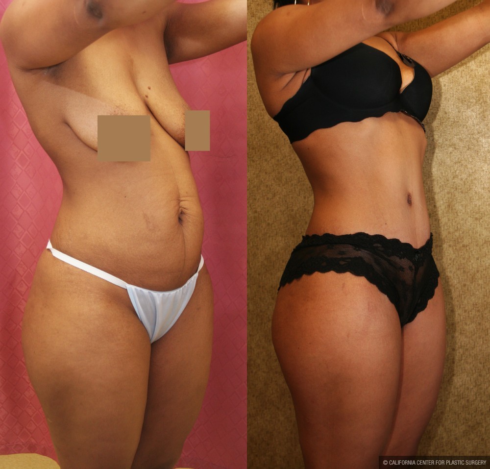 African American Tummy Tuck (Abdominoplasty) Before & After Patient #13430