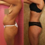 African American Tummy Tuck (Abdominoplasty) Before & After Patient #13430