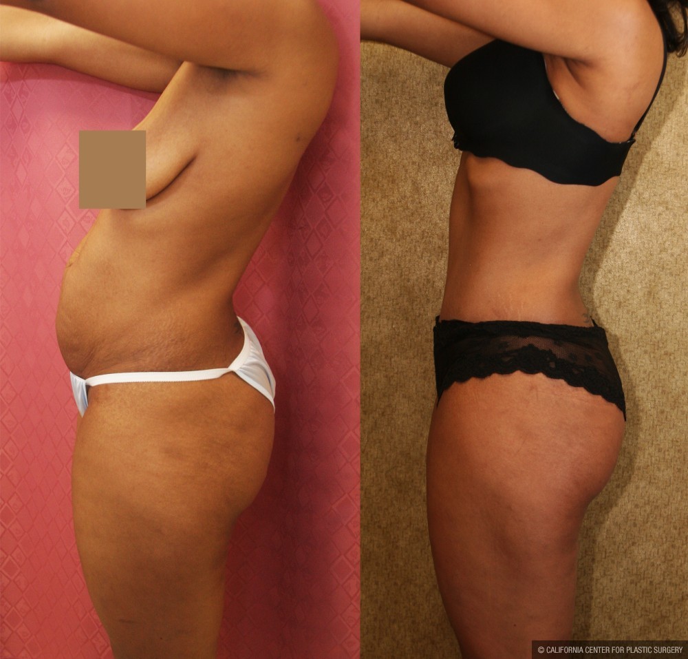 African American Tummy Tuck (Abdominoplasty) Before & After Patient #13430