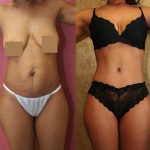 African American Tummy Tuck (Abdominoplasty) Before & After Patient #13430