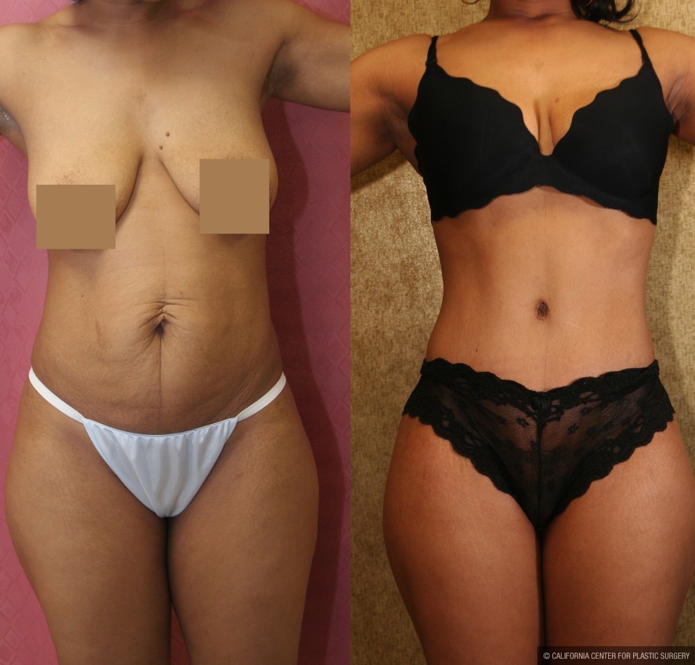 African American Tummy Tuck (Abdominoplasty) Before & After Patient #13430