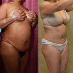 African American Tummy Tuck (Abdominoplasty) Before & After Patient #13451