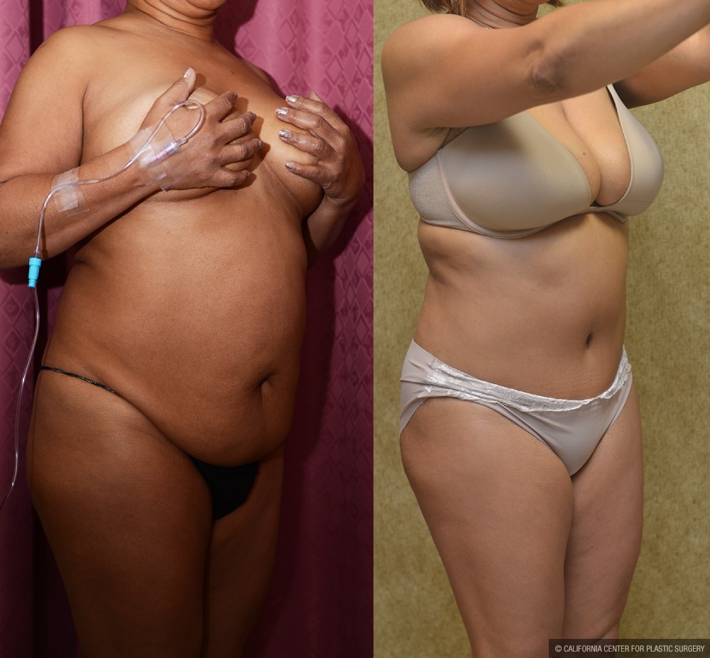 African American Tummy Tuck (Abdominoplasty) Before & After Patient #13451