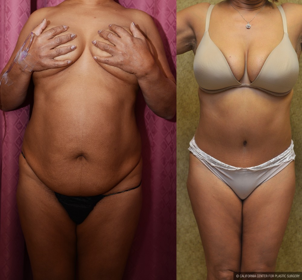 African American Tummy Tuck (Abdominoplasty) Before & After Patient #13451