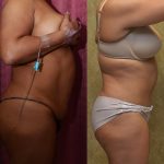 African American Tummy Tuck (Abdominoplasty) Before & After Patient #13451