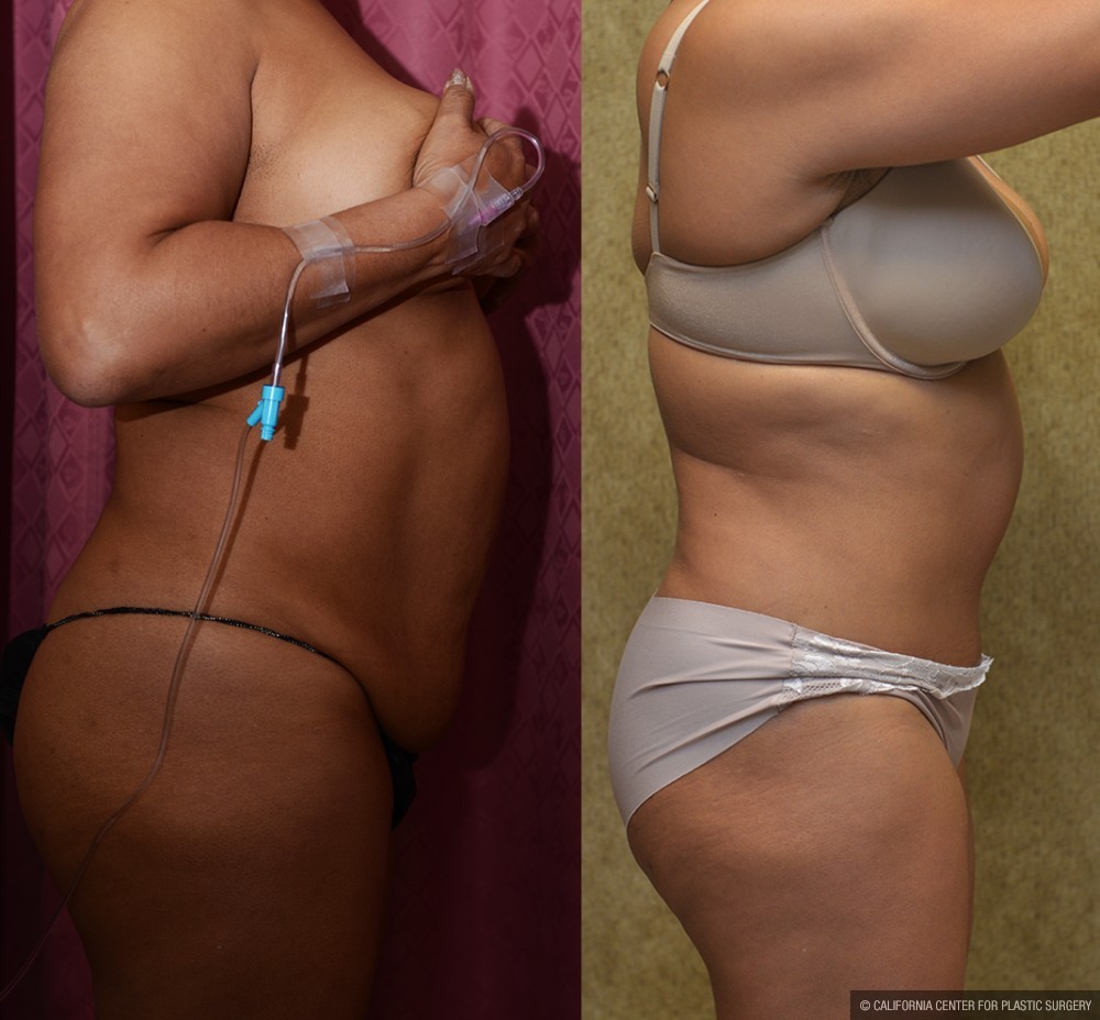 African American Tummy Tuck (Abdominoplasty) Before & After Patient #13451