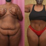 African American Tummy Tuck (Abdominoplasty) Before & After Patient #13443