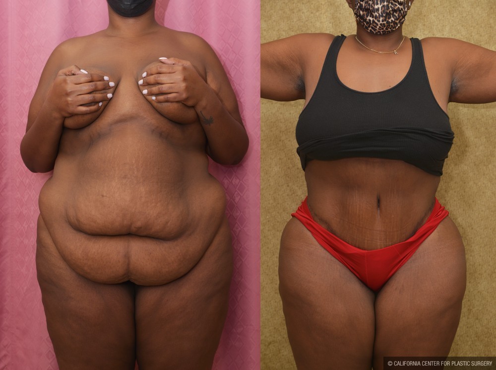 African American Tummy Tuck (Abdominoplasty) Before & After Patient #13443
