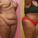 African American Tummy Tuck (Abdominoplasty) Before & After Patient #13443