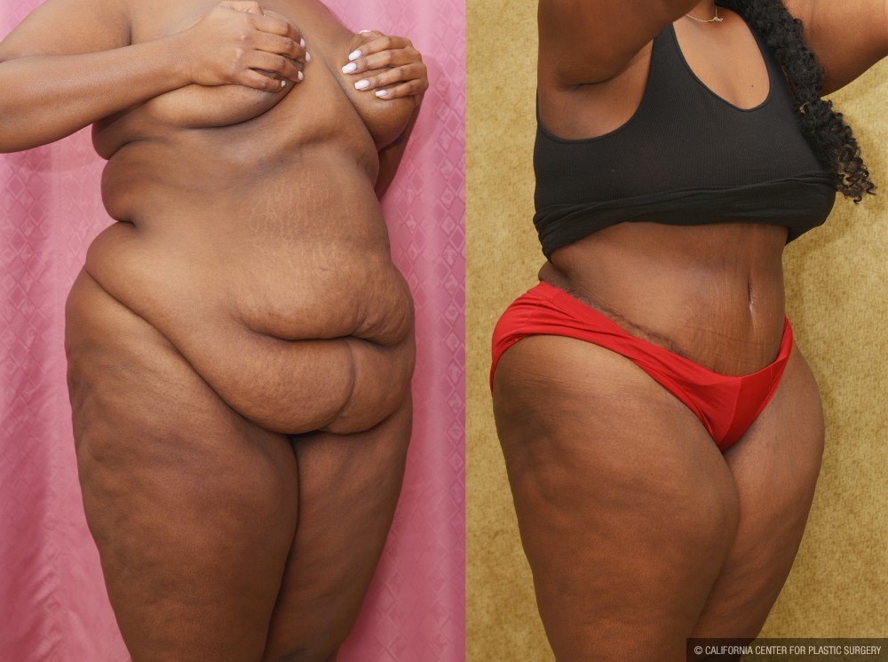 African American Tummy Tuck (Abdominoplasty) Before & After Patient #13443