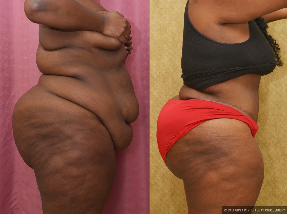 African American Tummy Tuck (Abdominoplasty) Before & After Patient #13443