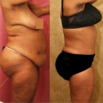 African American Tummy Tuck (Abdominoplasty) Before & After Patient #13473