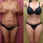 Tummy Tuck (Abdominoplasty) Small Size Before & After Patient #13480