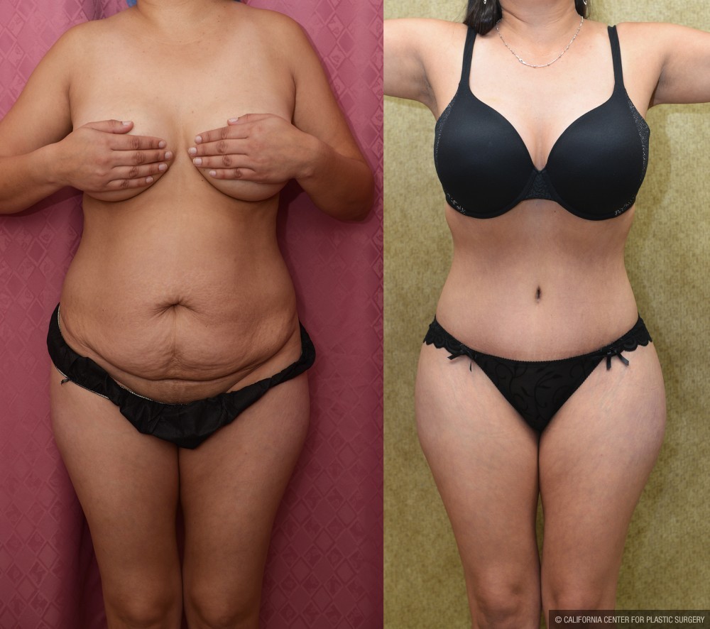 Tummy Tuck (Abdominoplasty) Small Size Before & After Patient #13480