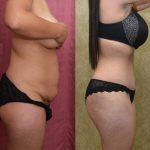 Tummy Tuck (Abdominoplasty) Small Size Before & After Patient #13480