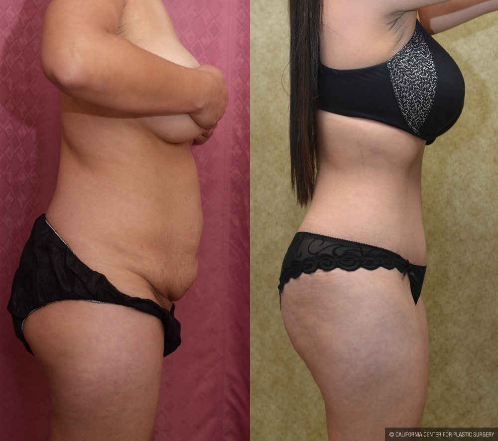 Tummy Tuck (Abdominoplasty) Small Size Before & After Patient #13480