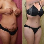Tummy Tuck (Abdominoplasty) Small Size Before & After Patient #13480