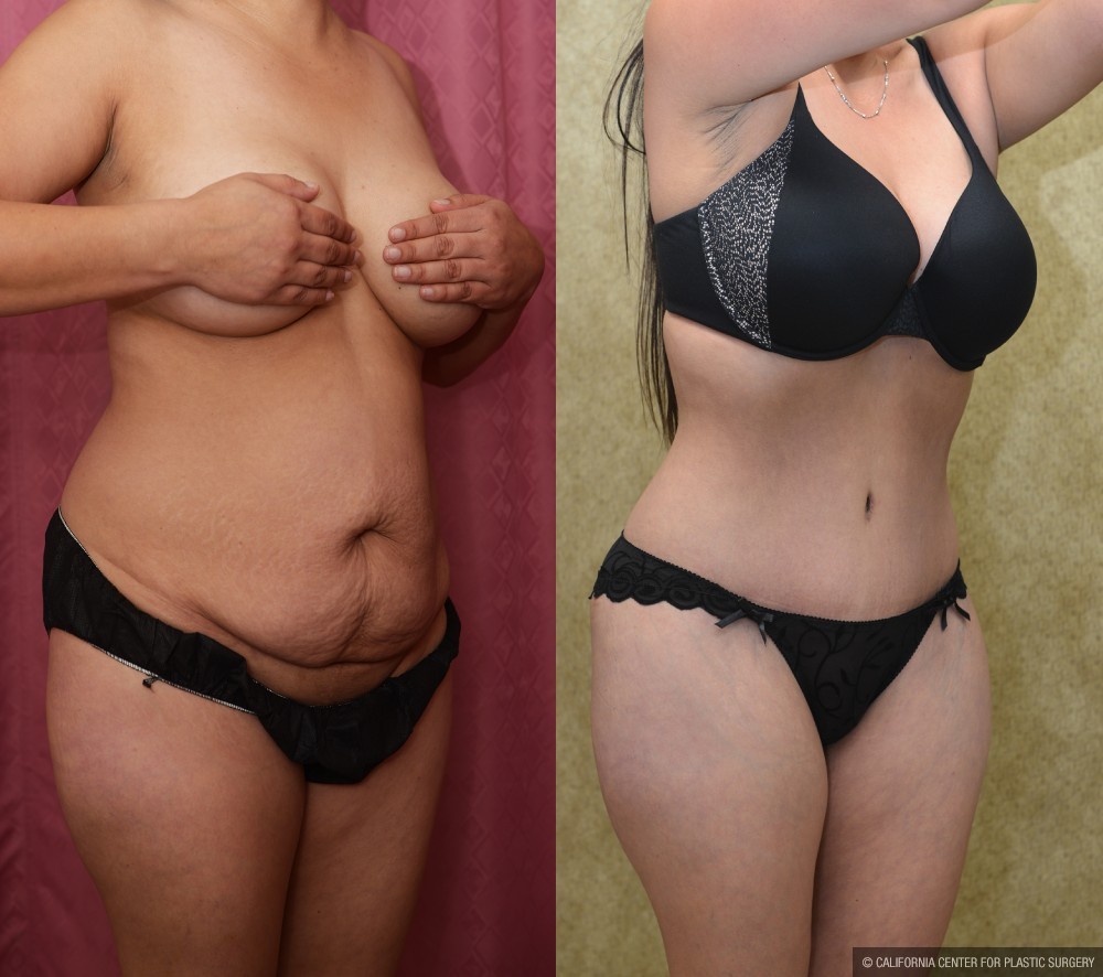 Tummy Tuck (Abdominoplasty) Small Size Before & After Patient #13480