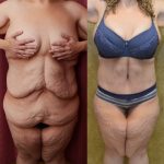 Body Lift Before & After Patient #13407