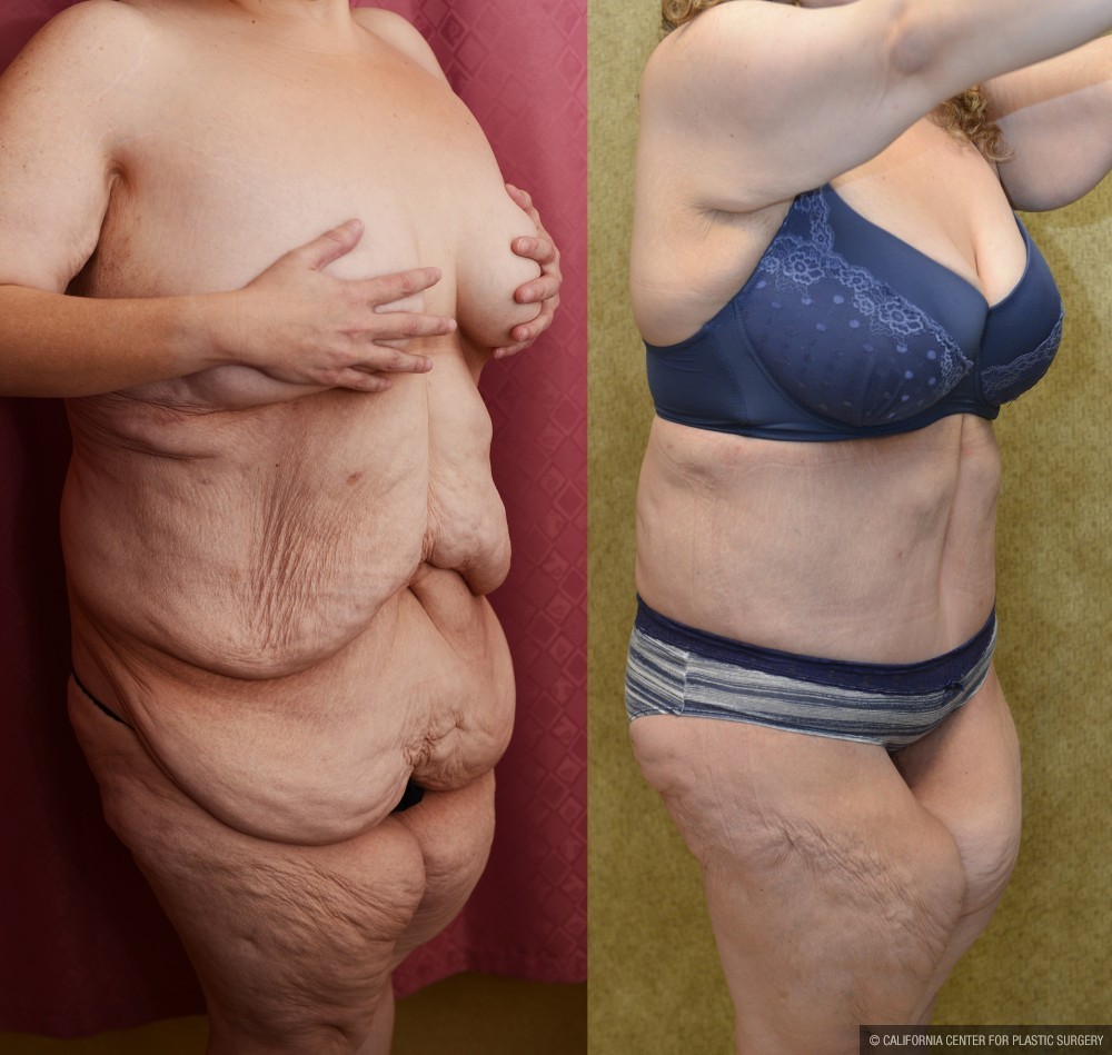 Body Lift Before & After Patient #13407