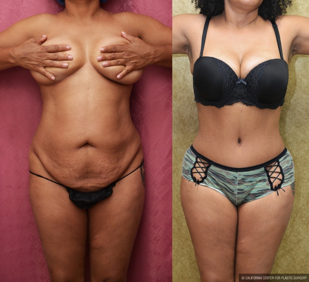 African American Tummy Tuck (Abdominoplasty) Before & After Patient #13424