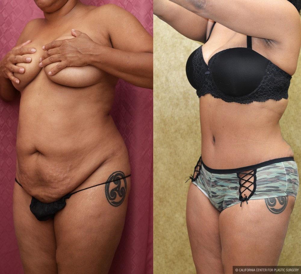 African American Tummy Tuck (Abdominoplasty) Before & After Patient #13424