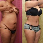 African American Tummy Tuck (Abdominoplasty) Before & After Patient #13424