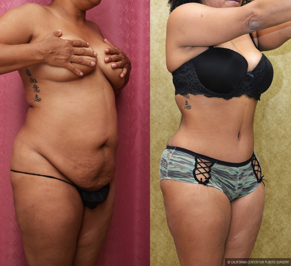 African American Tummy Tuck (Abdominoplasty) Before & After Patient #13424