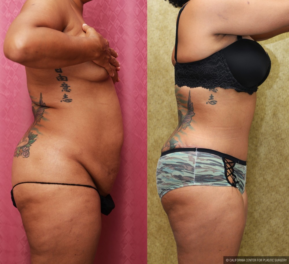 African American Tummy Tuck (Abdominoplasty) Before & After Patient #13424