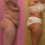 African American Tummy Tuck (Abdominoplasty) Before & After Patient #13469