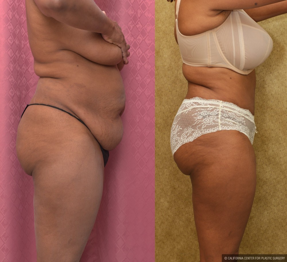 African American Tummy Tuck (Abdominoplasty) Before & After Patient #13469