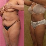 African American Tummy Tuck (Abdominoplasty) Before & After Patient #13469