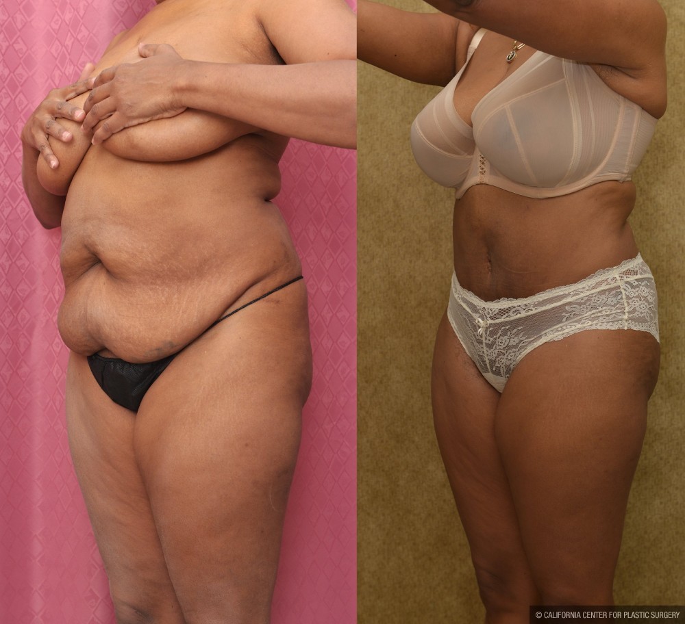 African American Tummy Tuck (Abdominoplasty) Before & After Patient #13469