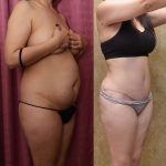 Tummy Tuck (Abdominoplasty) Small Size Before & After Patient #13488